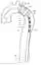 Fig. 01 - Thoracic arch stent graft and method of delivery