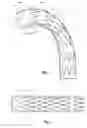 Fig. 02 - Thoracic arch stent graft and method of delivery