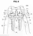 Fig. 07 - Dental implant