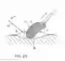 Fig. 04 - Drainage device for treating wounds using a reduced pressure