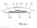 Fig. 06 - Drainage device for treating wounds using a reduced pressure