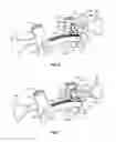 Fig. 07 - Surgical Instrument for Supplying a Counter-Torque When Securing a Spinal Prosthesis