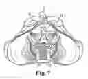 Fig. 04 - Prolapse repair