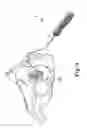 Fig. 06 - Prolapse repair