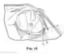 Fig. 07 - Prolapse repair