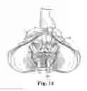 Fig. 09 - Prolapse repair