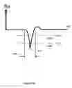 Fig. 05 - Methods and systems for management of atrial retrograde conduction and pacemaker mediated tachyarrhythmia