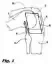 Fig. 02 - Bicondylar resurfacing prosthesis and method for insertion through direct lateral approach