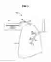 Fig. 02 - Intra-thoracic collateral ventilation bypass system