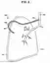 Fig. 07 - Intra-thoracic collateral ventilation bypass system