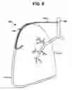 Fig. 08 - Intra-thoracic collateral ventilation bypass system