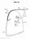 Fig. 09 - Intra-thoracic collateral ventilation bypass system