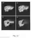 Fig. 32 - Apparatus and methods of compensating for organ deformation, registration of internal structures to images, and applications of same