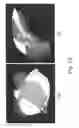Fig. 44 - Apparatus and methods of compensating for organ deformation, registration of internal structures to images, and applications of same