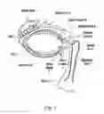 Fig. 02 - Method for preventing nasolacrimal duct obstruction