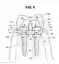 Fig. 07 - Dental implant