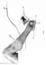 Fig. 02 - Method of treating a severe diabetic ulcer