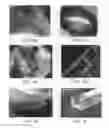 Fig. 02 - Tuned RF energy and electrical tissue characterization for selective treatment of target tissues