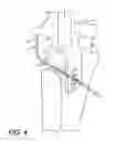 Fig. 06 - Orthopedic and dental implant system and method