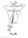 Fig. 52 - Devices for minimally invasive pelvic surgery