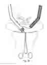 Fig. 58 - Devices for minimally invasive pelvic surgery