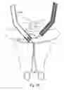 Fig. 59 - Devices for minimally invasive pelvic surgery