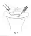 Fig. 63 - Devices for minimally invasive pelvic surgery