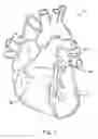 Fig. 02 - Methods and apparatus for transpericardial left atrial appendage closure