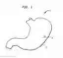 Fig. 02 - Gastrotomy closure device