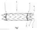 Fig. 02 - PROXIMAL FIXING