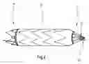 Fig. 03 - PROXIMAL FIXING