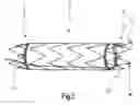 Fig. 04 - PROXIMAL FIXING