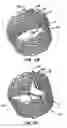 Fig. 04 - Methods and apparatus for endovascularly replacing a patient's heart valve
