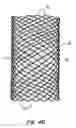 Fig. 10 - Methods and apparatus for endovascularly replacing a patient's heart valve
