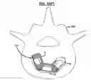 Fig. 16 - Articulating interbody spacer, vertebral body replacement