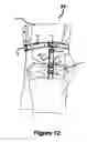 Fig. 13 - MULTIPLE PURPOSE STRAP-PACK SYSTEM