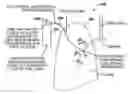 Fig. 01 - Variable resistance pulmonary ventilation bypass valve