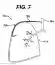 Fig. 06 - Variable resistance pulmonary ventilation bypass valve