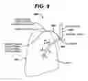 Fig. 08 - Variable resistance pulmonary ventilation bypass valve