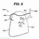 Fig. 05 - Variable resistance pulmonary ventilation bypass valve