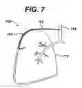 Fig. 06 - Variable resistance pulmonary ventilation bypass valve