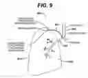 Fig. 08 - Variable resistance pulmonary ventilation bypass valve