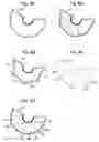 Fig. 09 - Tension cushion air bag module