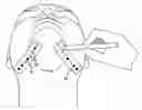Fig. 01 - LAMINATED SURGICAL TAPE AND METHOD FOR USING SAME