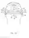 Fig. 33 - LAMINATED SURGICAL TAPE AND METHOD FOR USING SAME