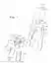 Fig. 02 - Minimal access lumbar diskectomy instrumentation and method