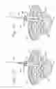 Fig. 09 - Minimal access lumbar diskectomy instrumentation and method