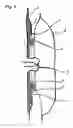 Fig. 02 - Ostomy Support Garment