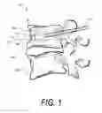 Fig. 02 - Composite implant and method for treating bone abnormalities