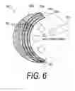 Fig. 06 - Composite implant and method for treating bone abnormalities